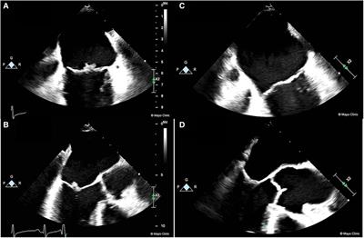 Case report: New is not always better: treatment of non-bacterial thrombotic endocarditis
